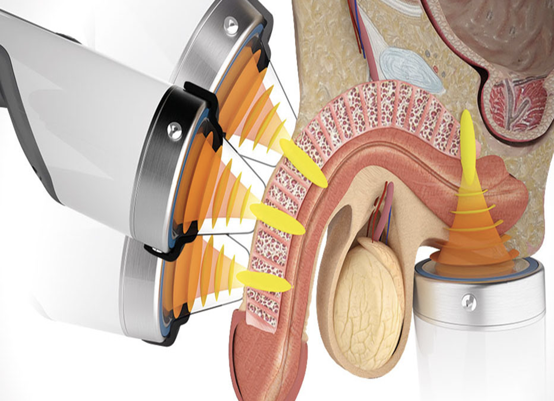 Skitse af ESWT-behandling