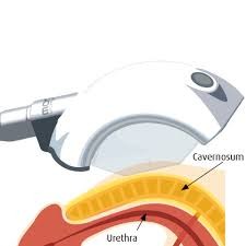 Erektildysfunktion01